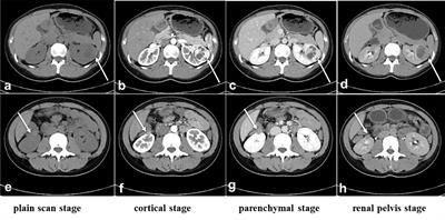 Case report: Going through pregnancy safely after twice partial nephrectomy for bilateral kidneys with HLRCC-associated RCC